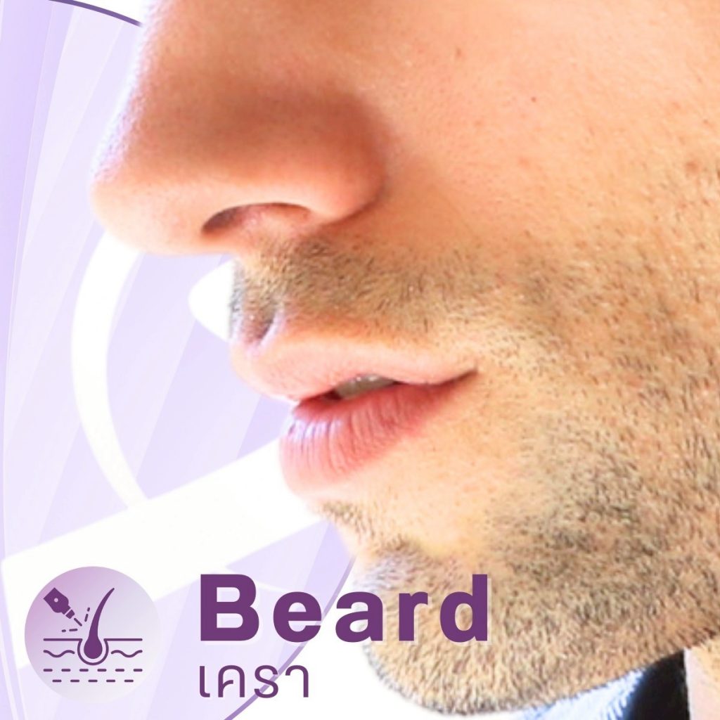 โปรแกรมบริเวณ Laser ของทางคลินิก-Beard