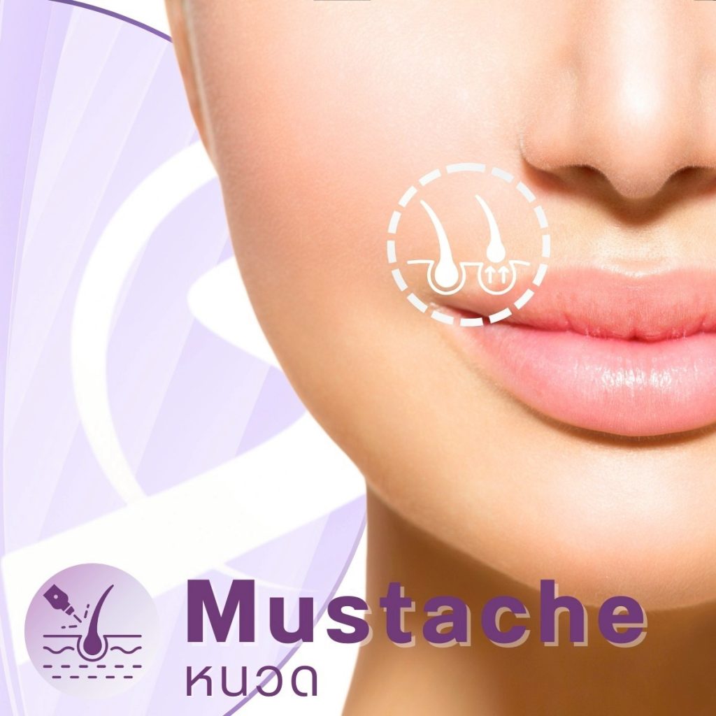 โปรแกรมบริเวณ Laser ของทางคลินิก-Mustacche